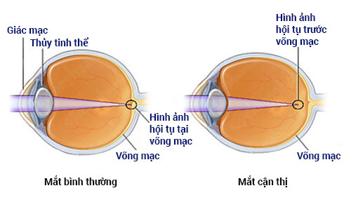 Tật khúc xạ cận thị điều trị bằng cách nào an toàn nhất?