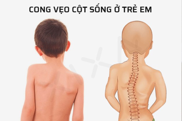 Tật khúc xạ và cong vẹo cột sống ở trẻ em – Đừng chủ quan!