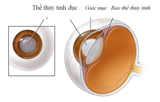 Tất tần tận về phẫu thuật phaco điều trị đục thủy tinh thể