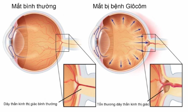 Tất tần tật những điều cần biết về bệnh glocom mắt