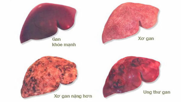 “Tất tần tật” thông tin về bệnh ung thư gan