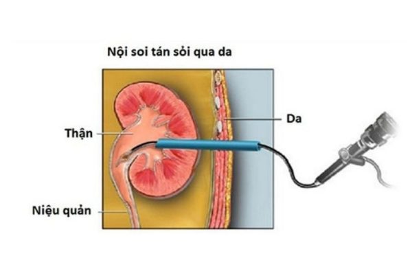 “Tất tần tật” thông tin về phương pháp tán sỏi thận qua da