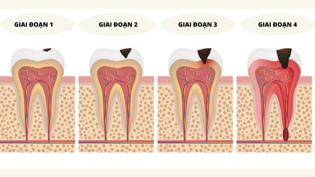 Tất tần tật về các phương pháp chữa sâu răng