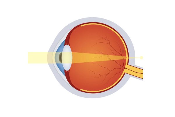 Tật viễn thị: Dấu hiệu, nguyên nhân, cách khắc phục