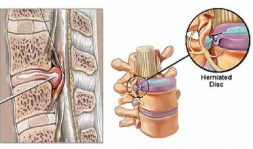 Tê buồn chân tay là dấu hiệu bệnh gì?