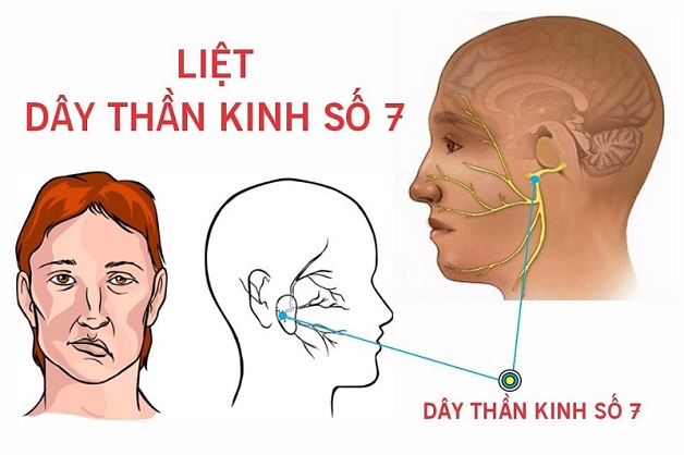 Tê liệt dây thần kinh số 7 có thể phục hồi được không?