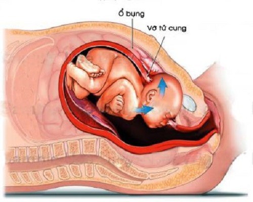 Thai ngoài tử cung bao lâu thì vỡ? câu hỏi