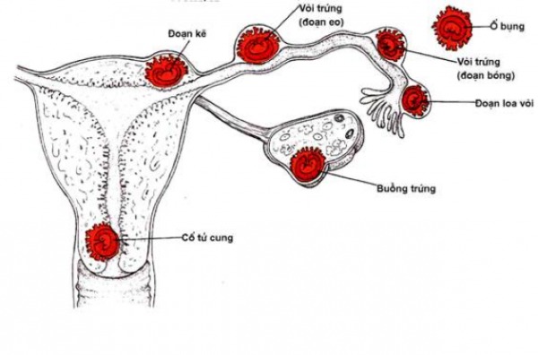 Thai ngoài tử cung đoạn kẽ