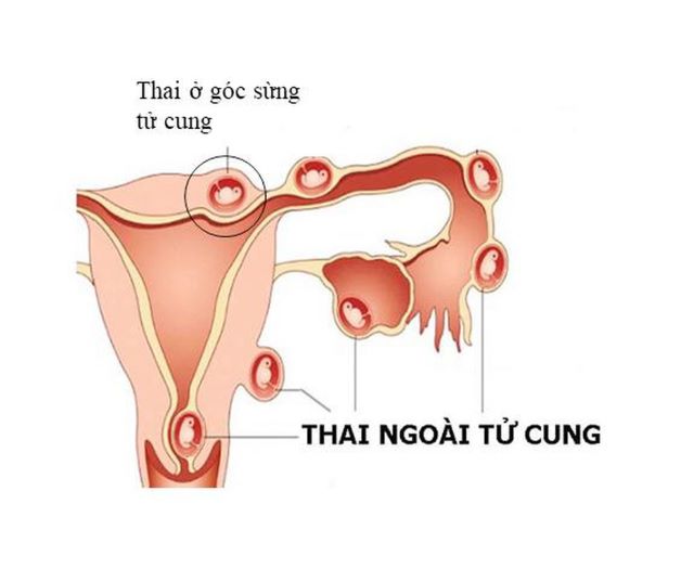 Thai ngoài tử cung niêm mạc dày bao nhiêu?