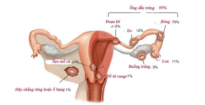 Thai ngoài tử cung thoái triển có bị vỡ không?