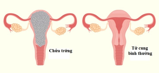 Thai trứng và những điều phụ nữ cần biết