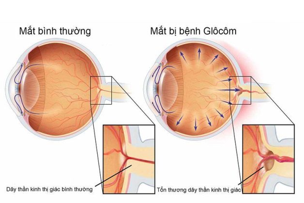 Thăm khám và điều trị ngay khi thấy dấu hiệu tăng nhãn áp