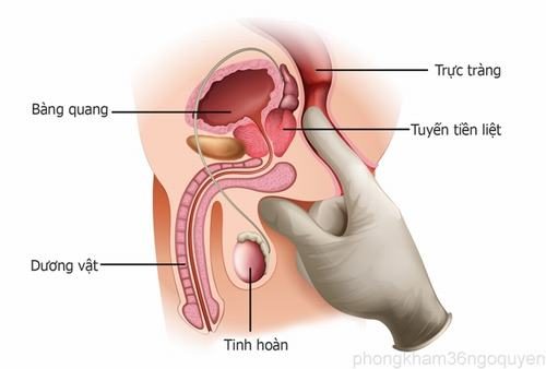 Thăm trực tràng u xơ tiền liệt tuyến