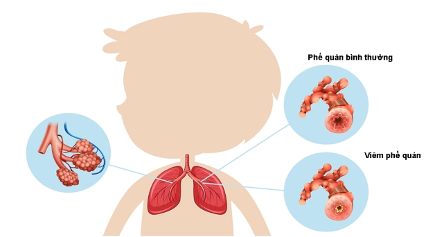 Thận trọng với viêm phế quản bội nhiễm ở trẻ em