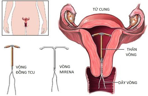 Tháo vòng tránh thai cần kiêng gì?