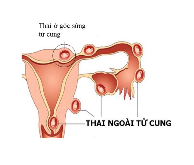 Thắt ống dẫn trứng có đau không, có nguy cơ gì không?