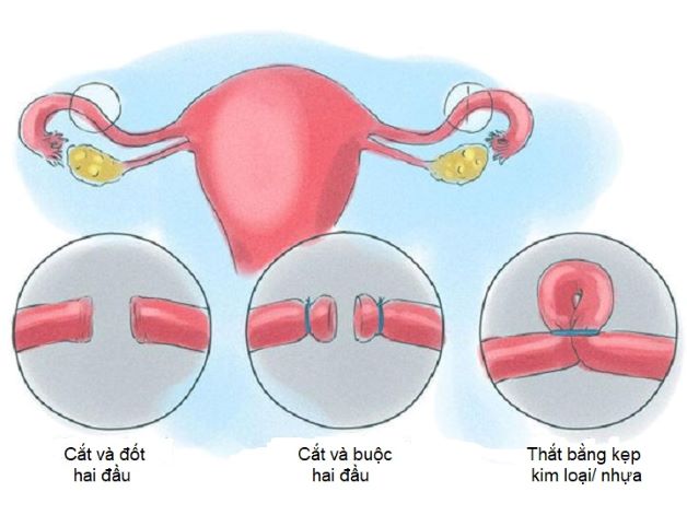 Thắt ống dẫn trứng có đau không, có nguy cơ gì không?