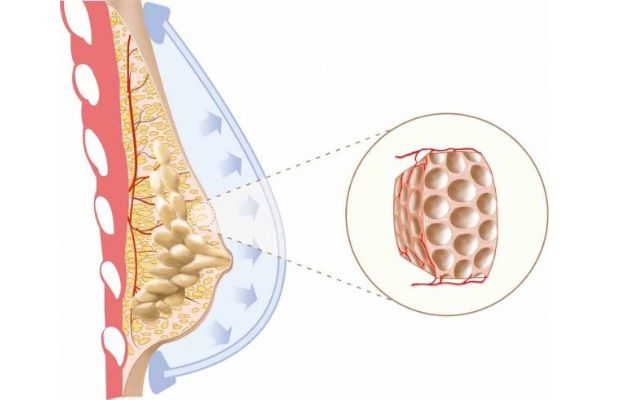 Thay đổi sợi bọc tuyến vú: Nguyên nhân, cách điều trị