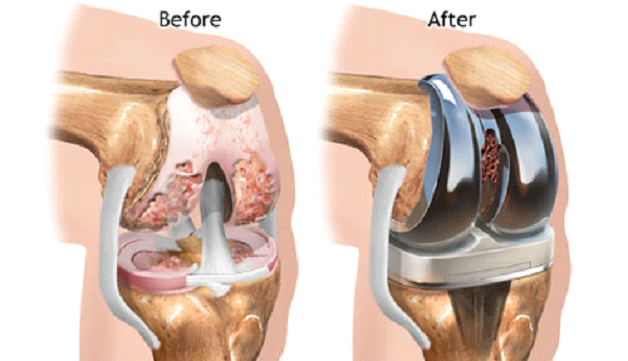 Thay khớp nhân tạo: Giải pháp chữa bệnh cơ xương khớp hiện đại