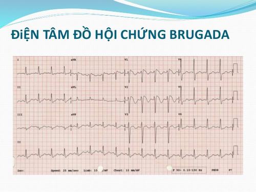 Thế nào là hội chứng Brugada về tim mạch