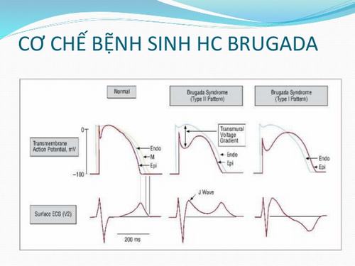 Thế nào là hội chứng Brugada về tim mạch