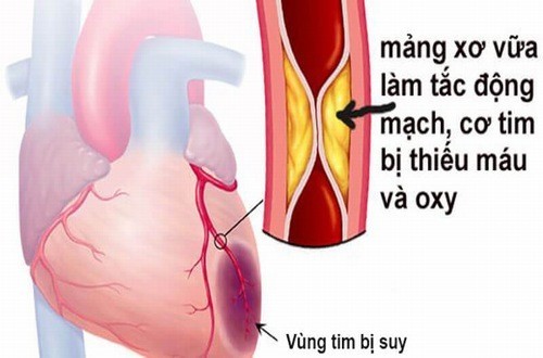 Thiếu máu cơ tim có phòng được không?