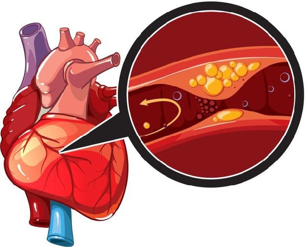 Thiếu máu cơ tim cục bộ: Nguyên nhân, triệu chứng