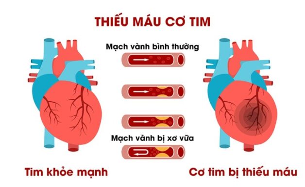 Thiếu máu cơ tim nên ăn gì và lưu ý chế độ ăn uống