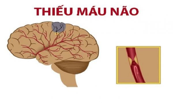 Thiếu máu lên não triệu chứng nhận biết và cách xử trí