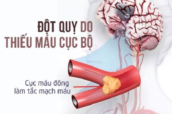 Thiếu máu lên não triệu chứng nhận biết và cách xử trí