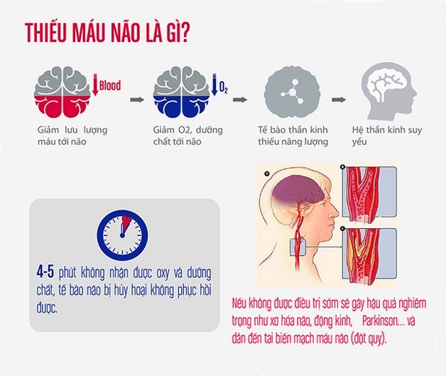 Thiếu máu não “con đường” dẫn đến đột quỵ