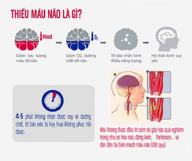 Thiếu máu não cục bộ là gì? Cơ chế hình thành