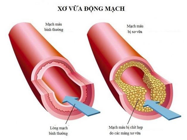 Thiếu máu não cục bộ là gì? Cơ chế hình thành