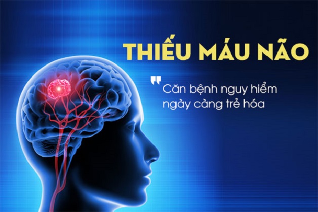 Thiếu máu não là gì? Nguyên nhân và triệu chứng