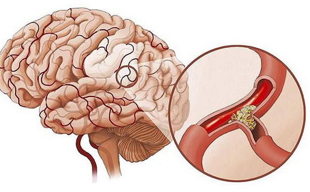 Thiếu máu não là gì? Nguyên nhân và triệu chứng