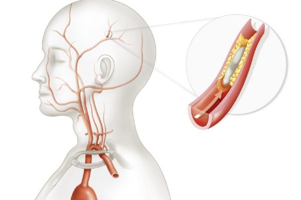 Thiếu máu não mãn tính nhận biết và phòng ngừa