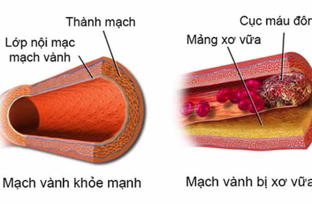 Thiếu máu não mất ngủ: Đâu là “hung thủ” gây bệnh?