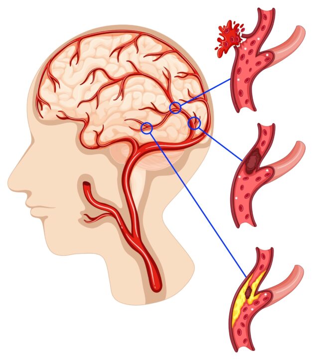 Thiếu máu não nguy hiểm không và cách điều trị