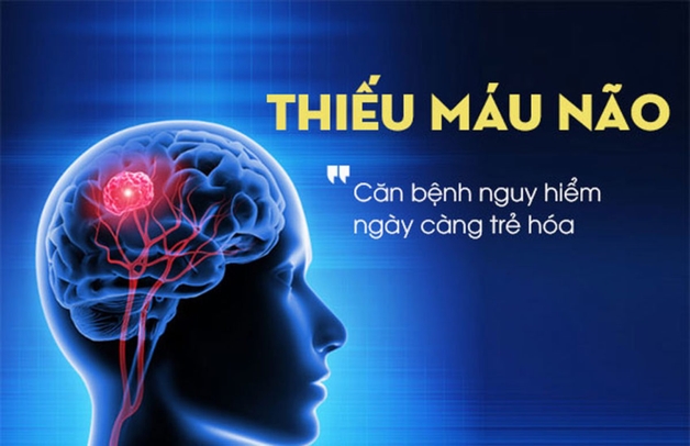 Thiếu máu não nguyên nhân do đâu? Cách phòng, trị bệnh