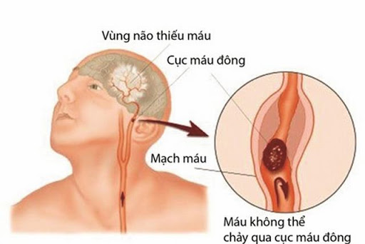 Thiếu máu não thoáng qua tưởng nhẹ nhưng vô cùng nguy hiểm