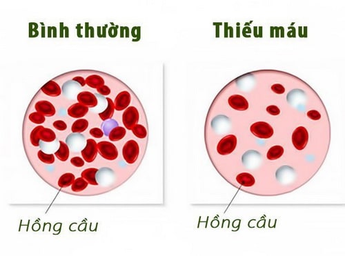 Thiếu máu ở trẻ em nguyên nhân và cách điều trị