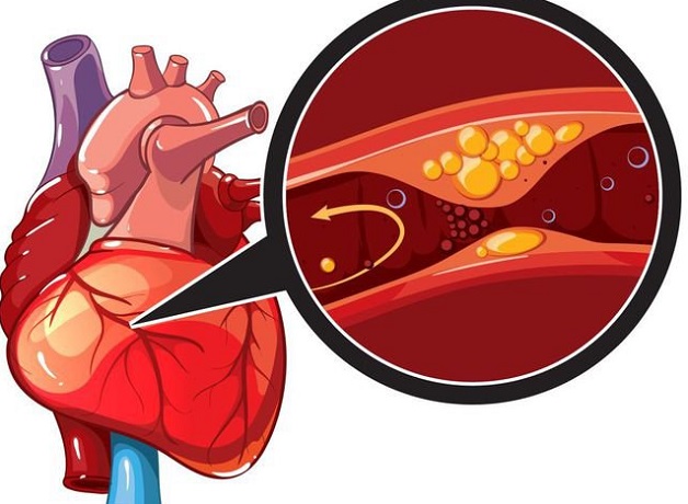 Thiếu máu tim cục bộ và hiểm họa tiềm ẩn