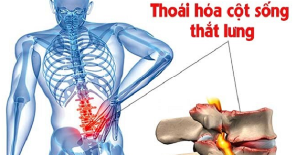 Thoái hóa cột sống thắt lưng hay gặp ở đối tượng nào?