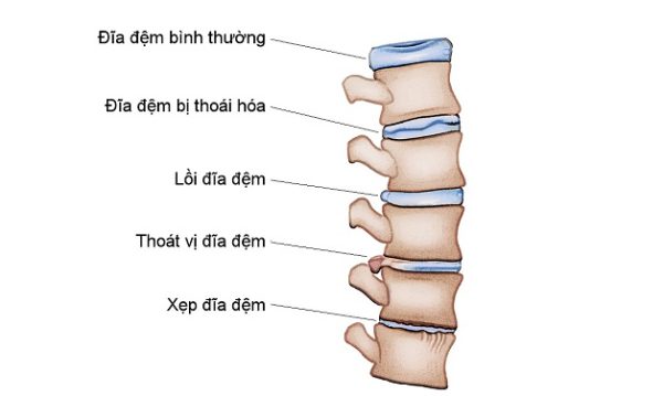 Thoái hóa cột sống thắt lưng hay gặp ở đối tượng nào?