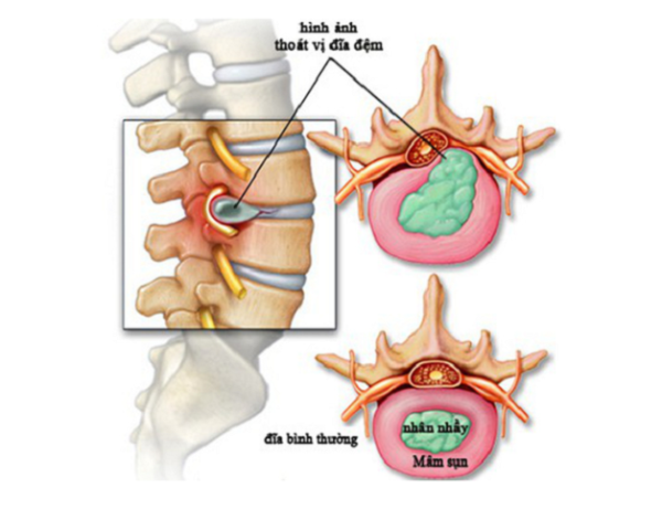 Thoái hóa cột sống thoát vị đĩa đệm có điều trị khỏi được không? 