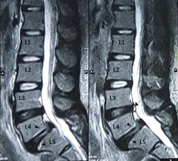 Thoái hóa cột sống thoát vị đĩa đệm có điều trị khỏi được không? 