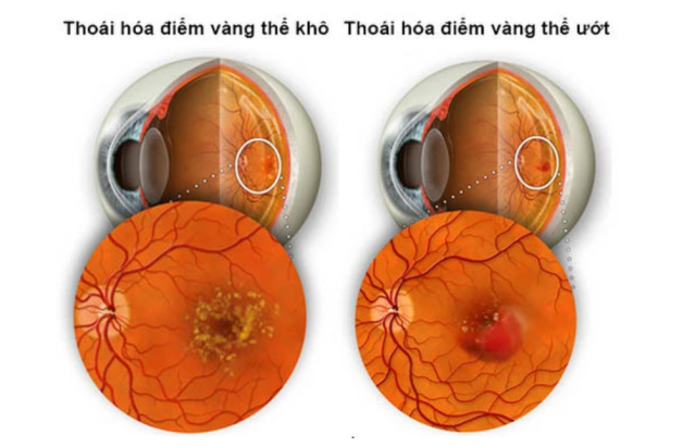 Thoái hóa hoàng điểm mắt là gì? Nguyên nhân do đâu?