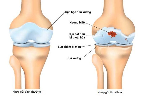 Thoái hóa khớp gối có chữa được không?