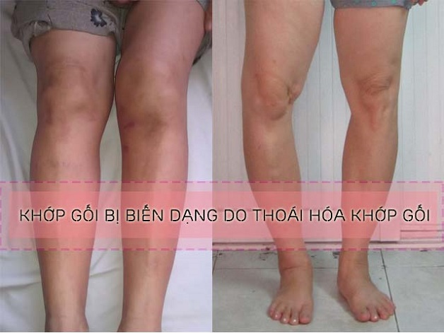 Thoái hóa khớp gối là gì? Biến chứng, cách điều trị