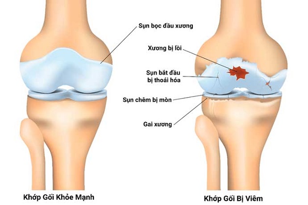 Thoái hóa khớp gối là gì và điều trị như thế nào?